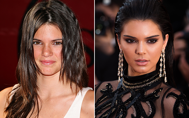 kendall-jenner-antes-depois