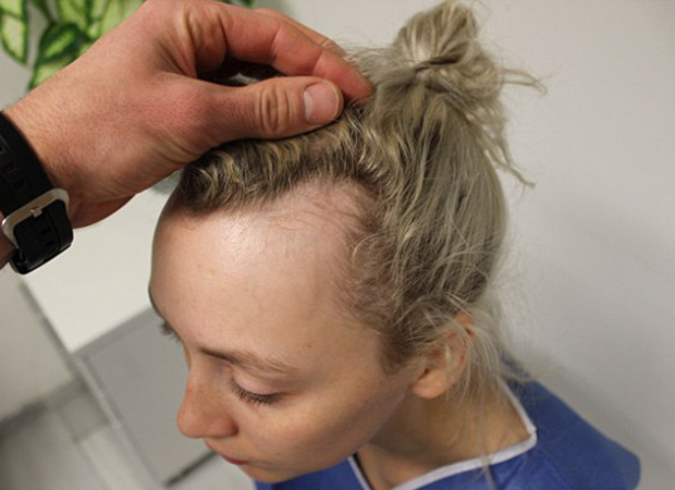 Garota perde parte do cabelo por fazer penteados apertados demais