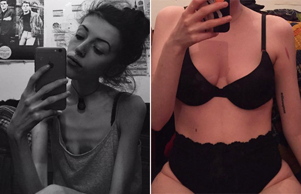#selflove: Jovem usa Instagram como diário para superar anorexia