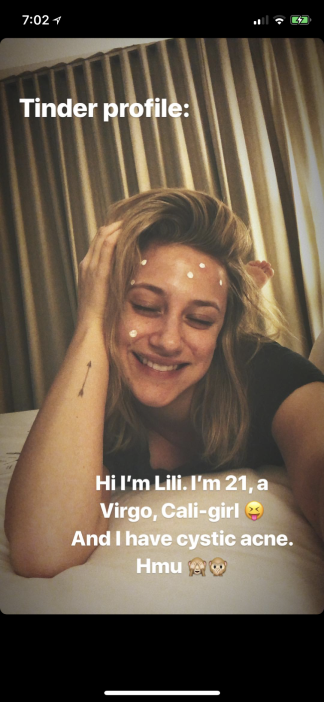 lili-reinhart-acne lili-reinhart-acne