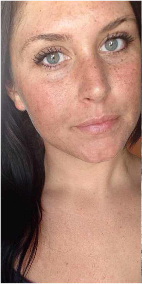 Mulher mostra antes e depois dos efeitos do sol na pele e choca a web! |  Capricho