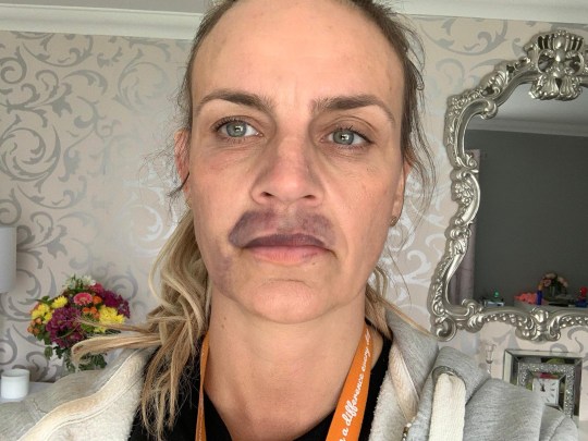 Mulher faz preenchimento labial e fica com hematomas 2