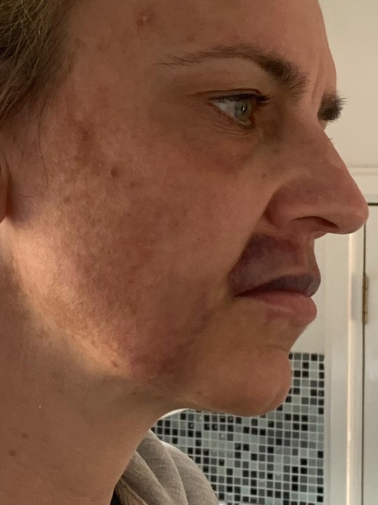 Mulher faz preenchimento labial e fica com hematomas