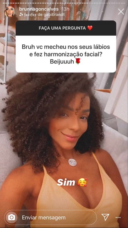 brunna goncalves harmonizacao facial (1)