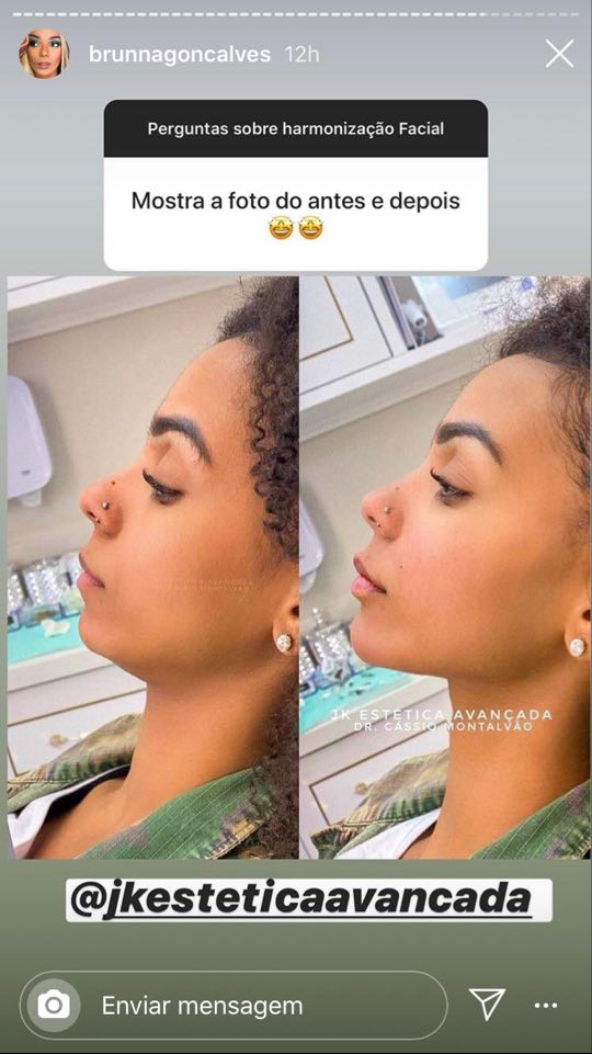 brunna goncalves harmonizacao facial (2) brunna goncalves harmonizacao facial (2)