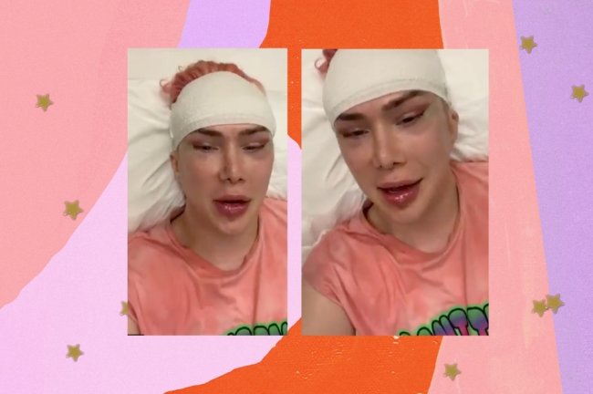 Print de vídeo mostrando o resultado da cirurgia do influenciador Oli London, ele aparece com o rosto inchado, os olhos puxados e a cabeça enfaixada.