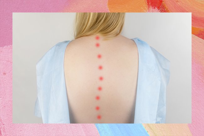 Escoliose idiopática do adolescente: o que é, causas, sintomas, tratamento Foto de uma mulher loira de costas, com um roupão de hospital aberto, mostrando a coluna desalinhada