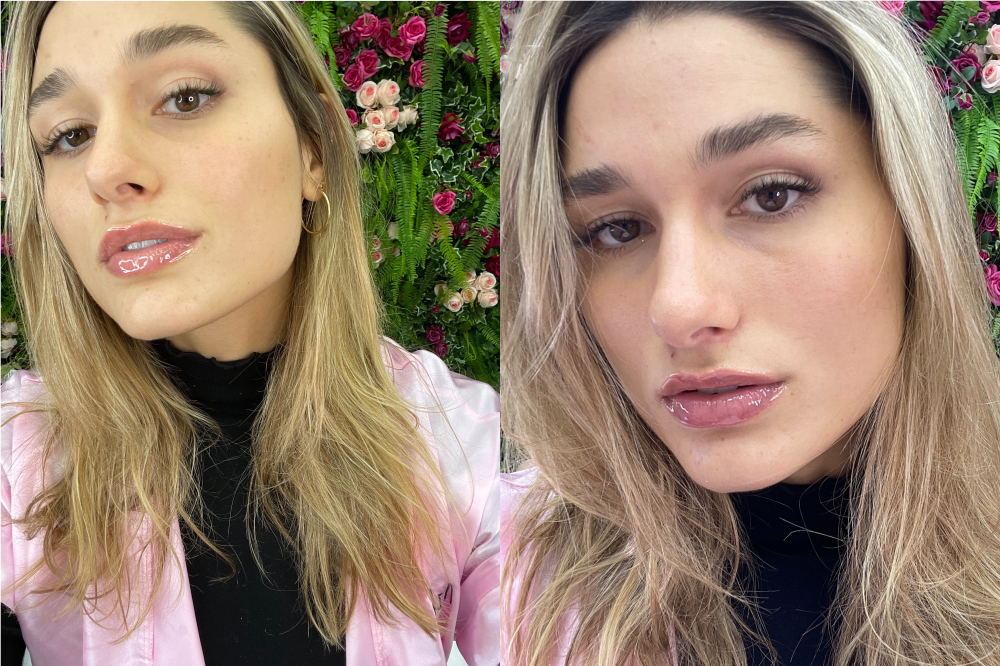 Montagem com duas selfies da Sasha Meneghel após ter feito um procedimento para deixar os lábios mais volumosos. Ela está usando uma blusa preta, jaqueta rosa e com expressão facial séria.