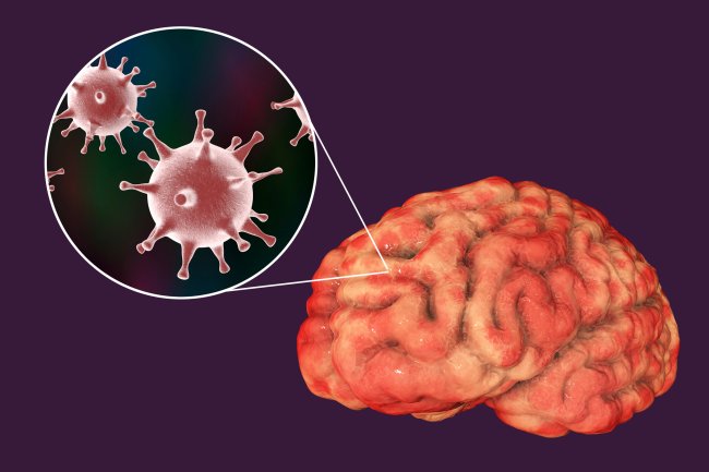 Ilustração da herpes simples acometendo uma infecção no cérebro