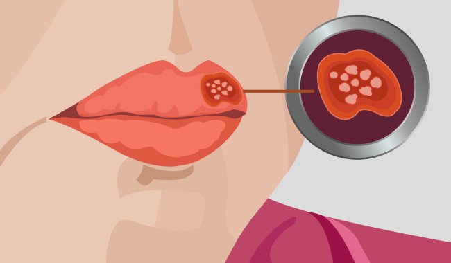 Ilustração da herpes labial, com uma boca com feridinhas