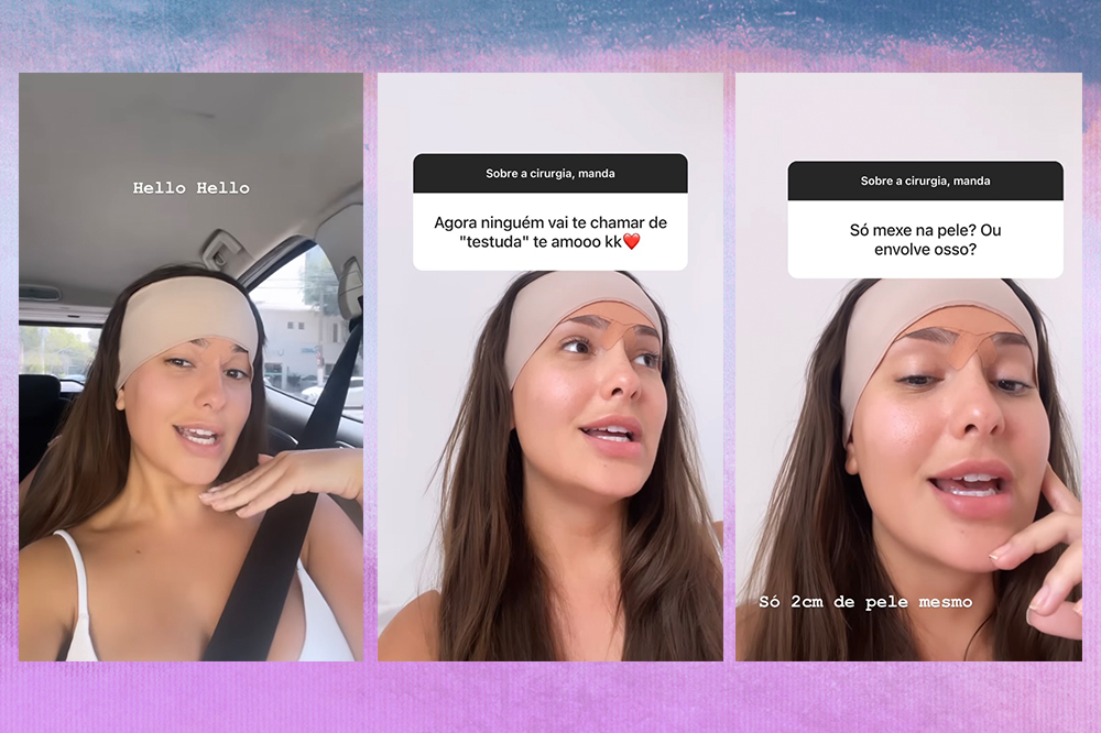 thais-braz-cirurgia-frontoplastia-testa-02 Montagem em fundo degradê azul e roxo de três Stories da ex-BBB Thais Braz mostrando o pós da sua cirurgia na testa