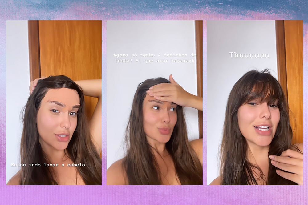 thais-braz-cirurgia-frontoplastia-testa-03 Montagem em fundo degradê azul e roxo de três Stories da ex-BBB Thais Braz mostrando o pós da sua cirurgia na testa