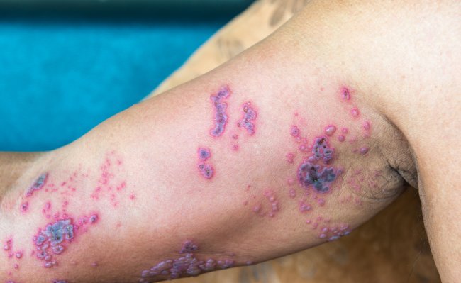 Bolhas arroxeadas na pele causada pela varíola