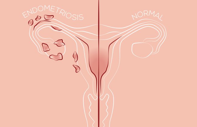 Ilustração de um útero com e sem endometriose