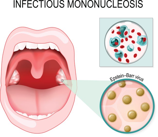 O que é a Mononucleose (doença do beijo)?