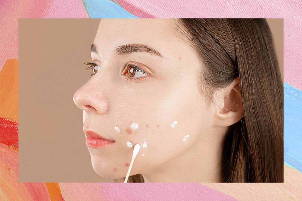 Montagem em fundo rosa, azul e laranja com foto de garota de perfil com expressão facial séria aplicando produto com cotonete nas espinhas