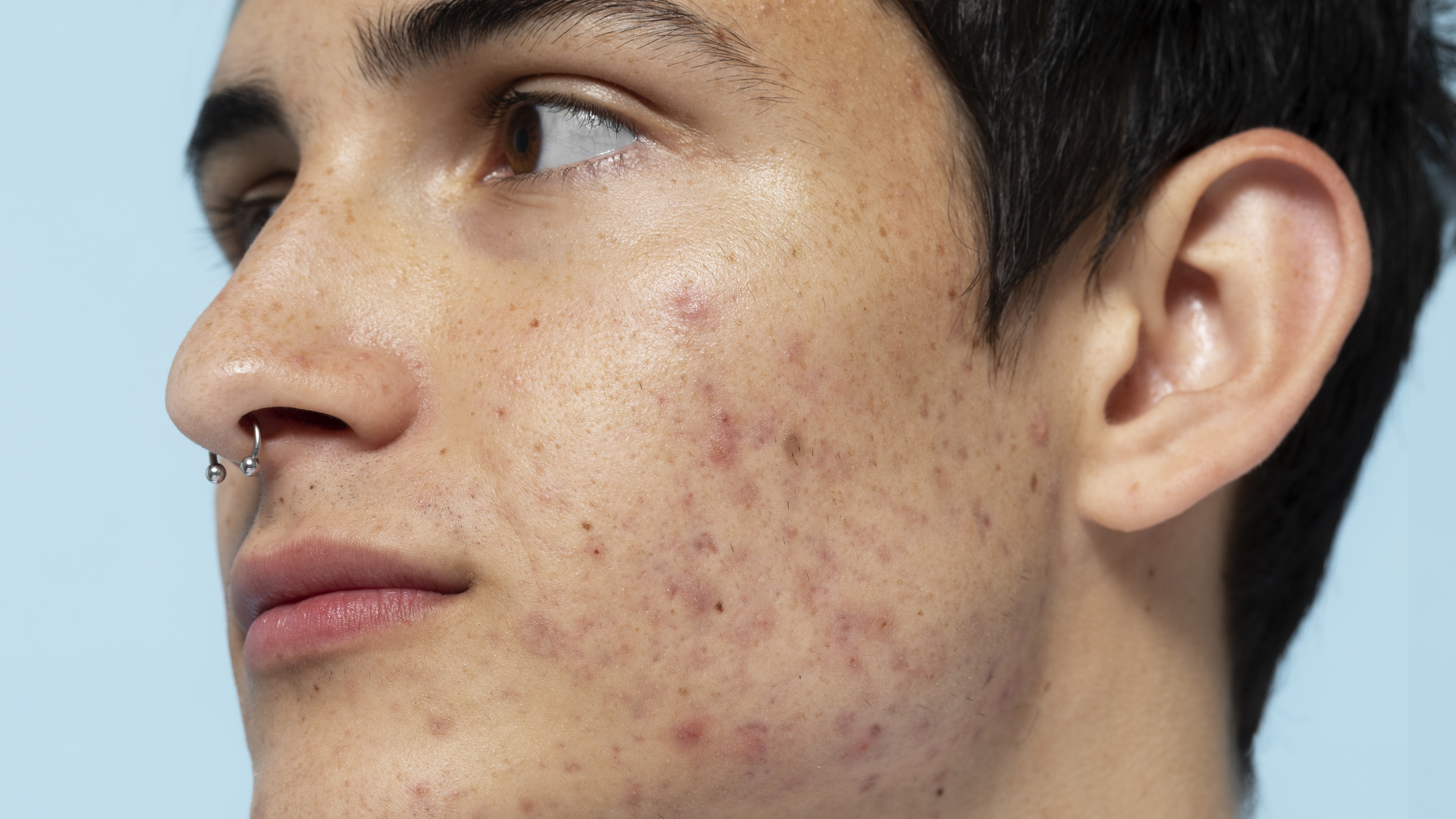 garoto-com-acne Garoto visto de perfil com pele acneica
