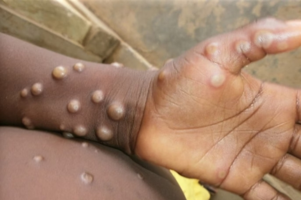 Doença da Mpox pode se apresentar com lesões na pele