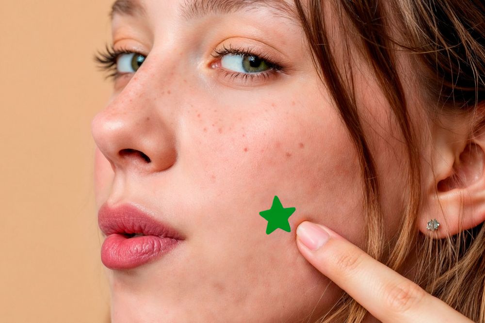 Garota usa adesivo secativo de espinha em formato de estrela